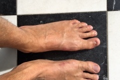 Bunion Surgery After