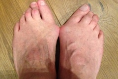 Bunion Surgery Before