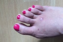 Bunion Surgery After