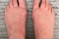 Bunion Surgery After