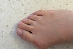 Bunion Surgery Before