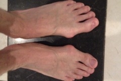 Bunion Surgery Before